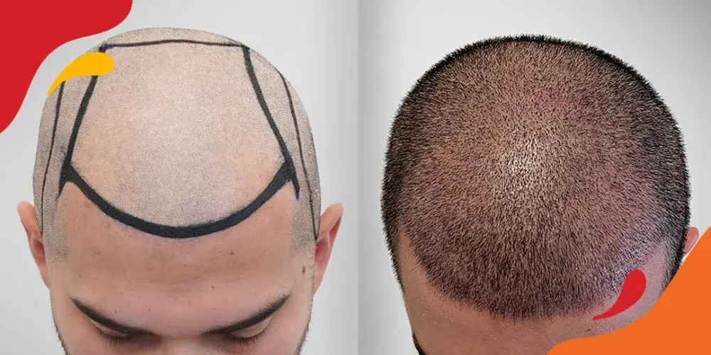 cara mengatasi garis rambut mundur